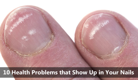 10 Health Problems that Show Up in Your Nails - Crunchy Moms