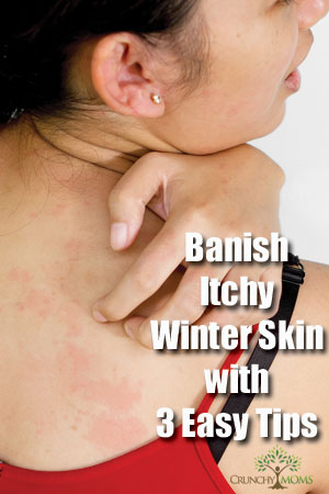 itchy skin, winter, crunchy moms, dry air, itchiness, crunchy, hydrated, tea, health, crunchy mom, humidifier, laundry detergent, moisturizers, coconut oil